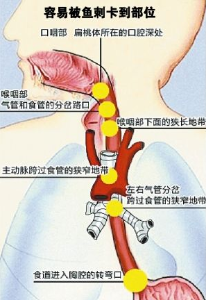 鱼刺卡喉咙电子喉镜显神通