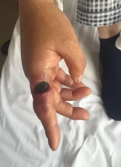 如何预防炭疽