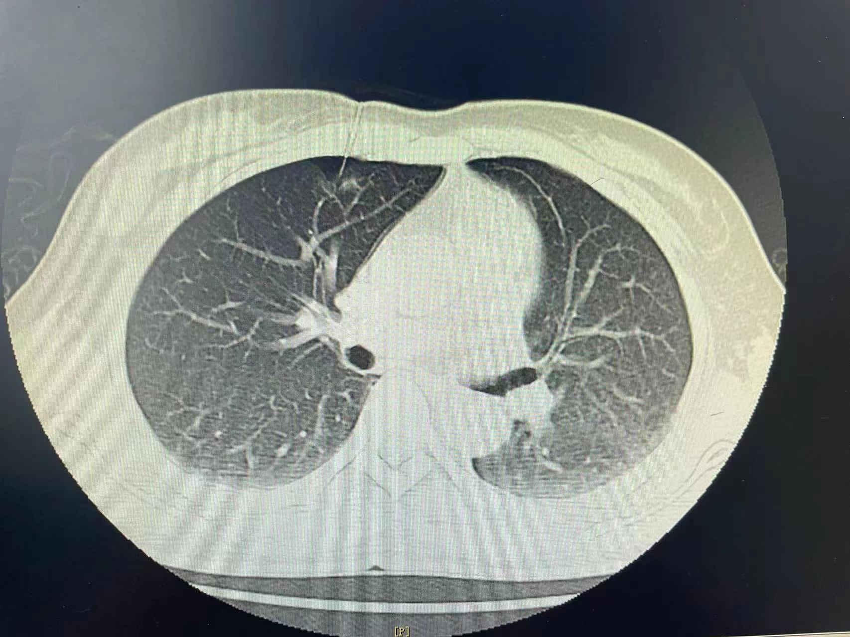 读懂肺结节（二）：肺结节的相关影像检查 - 知乎